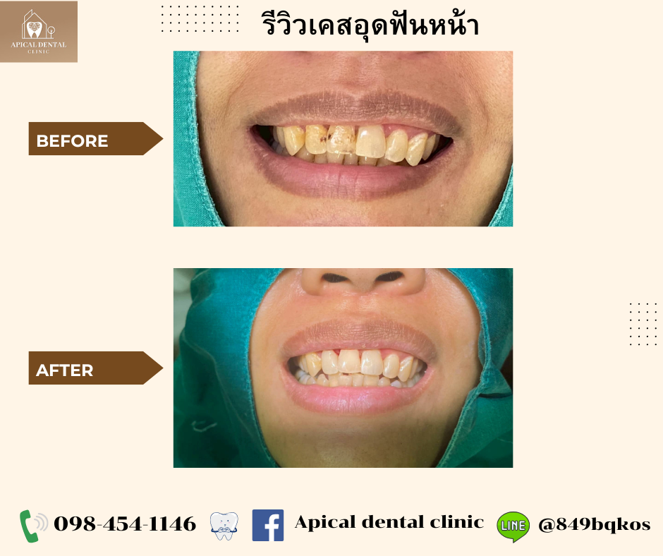ตัวอย่างการดูแลสุขภาพช่องปาก คลินิกทันตกรรมแอพพิคัล