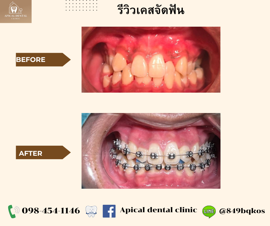 Before After จัดฟันแบบโลหะ คลินิกทันตกรรมแอพพิคัล