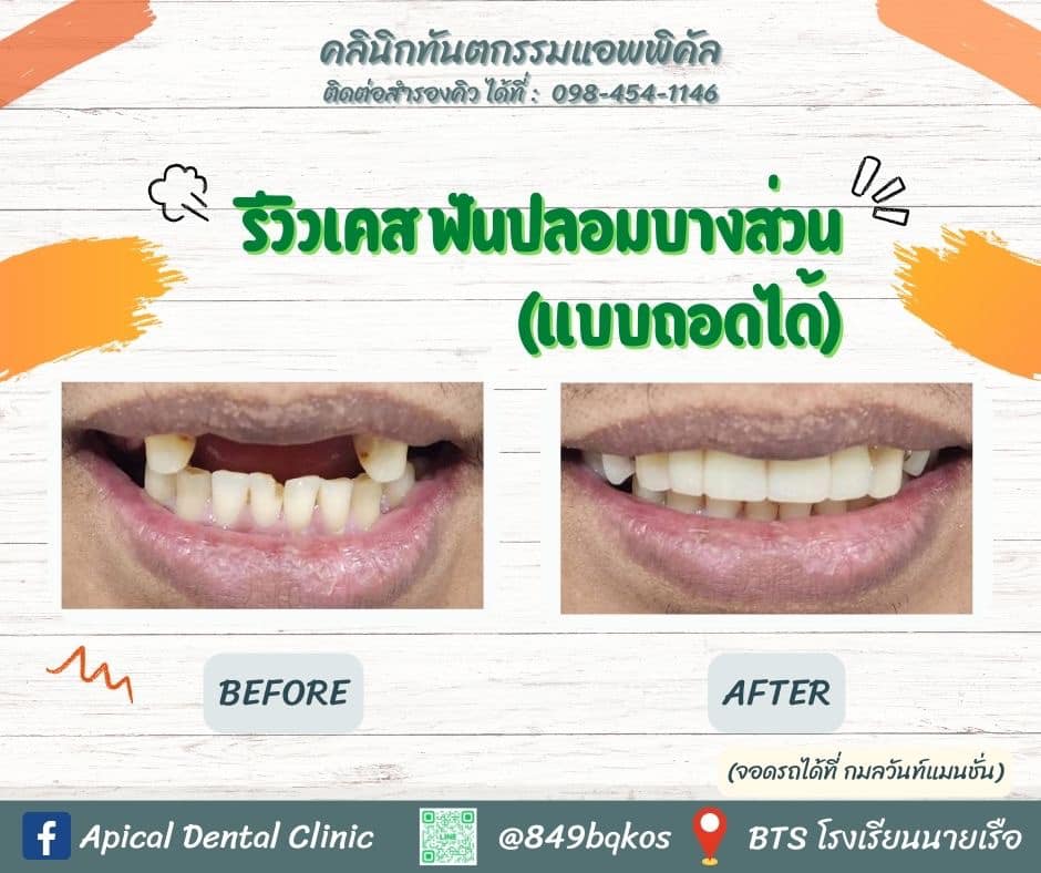 Before After ฟันปลอม คลินิกทันตกรรมแอพพิคัล