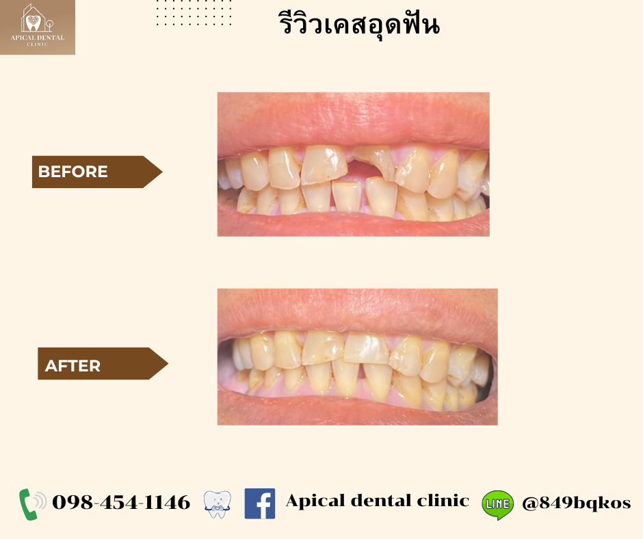 รีวิวเคสอุดฟัน คลินิกทันตกรรมแอพพิคัล
