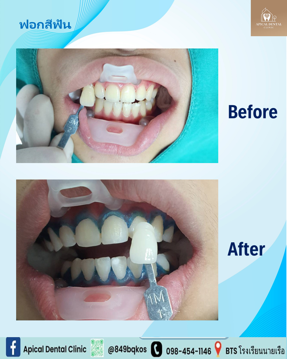Before After ฟอกสีฟัน คลินิกทันตกรรมแอพพิคัล