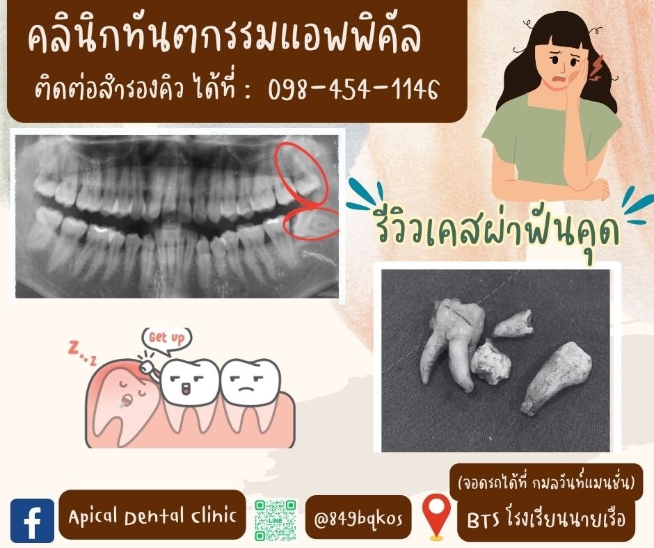 รีวิวเคสผ่าฟันคุด คลินิกทันตกรรมแอพพิคัล
