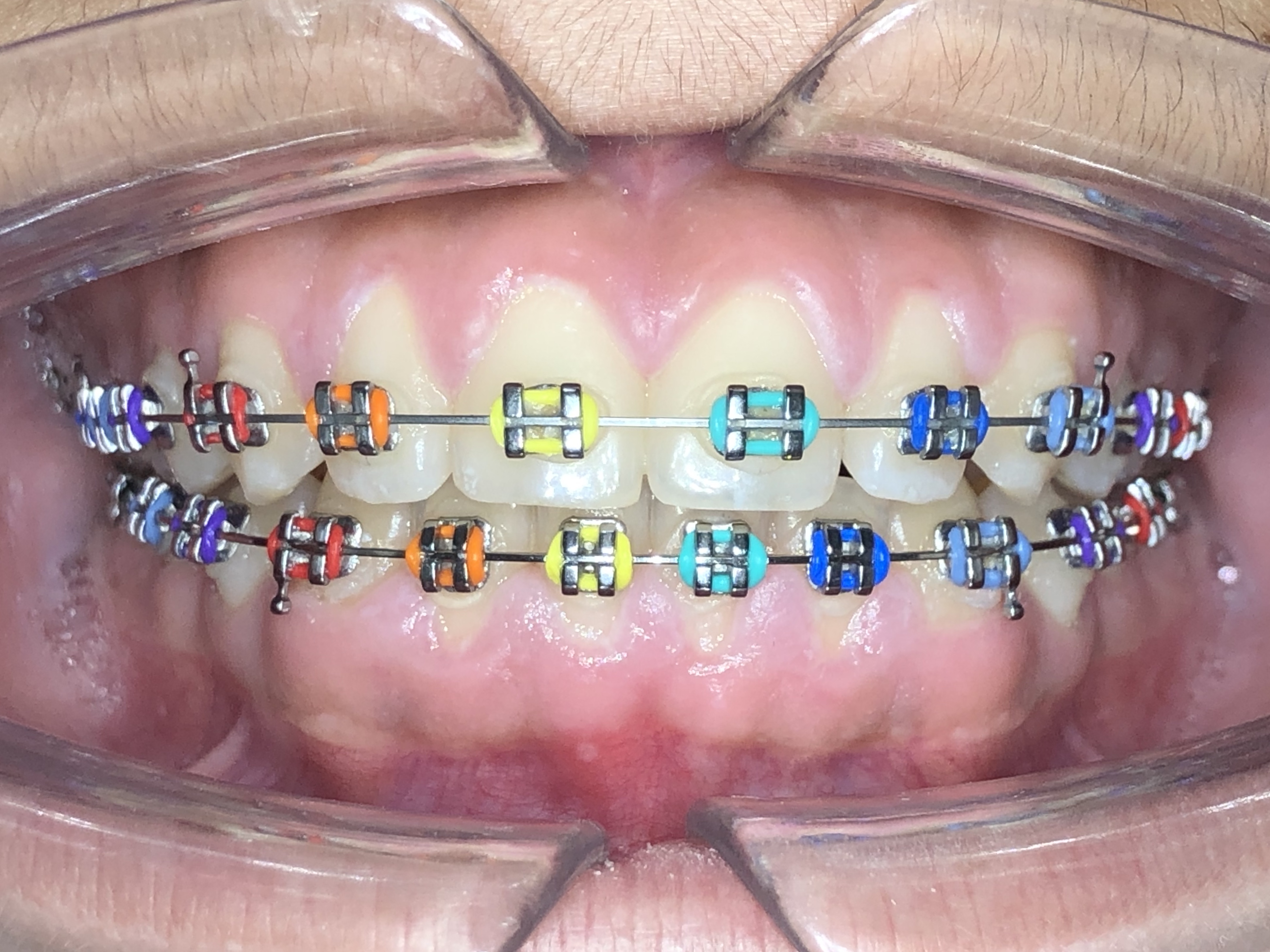 จัดฟันแบบโลหะ Metal Braces คลินิกทันตกรรมแอพพิคัล