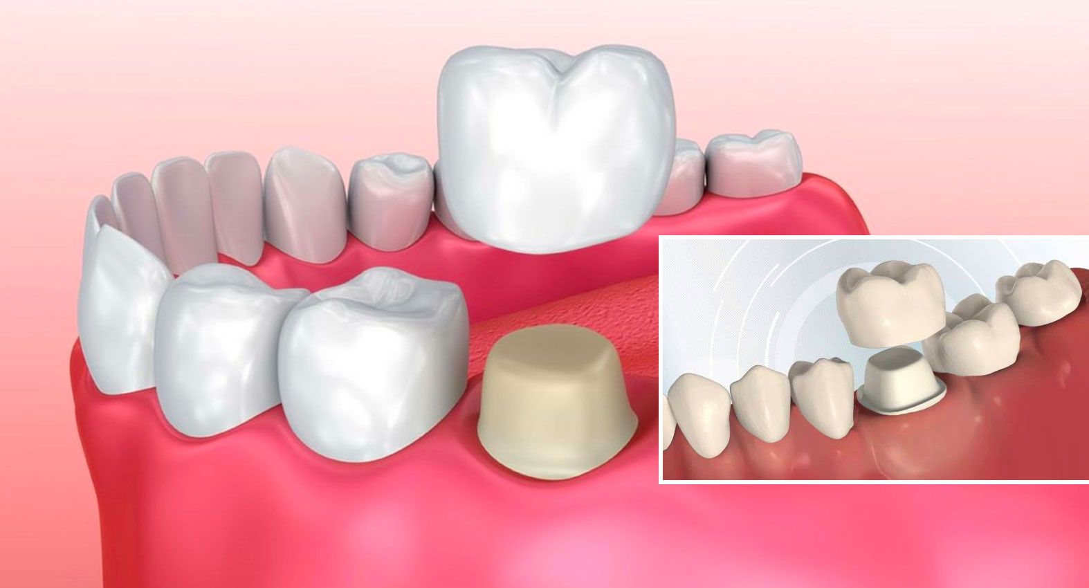 ครอบฟัน Dental Crown คลินิกทันตกรรมแอพพิคัล