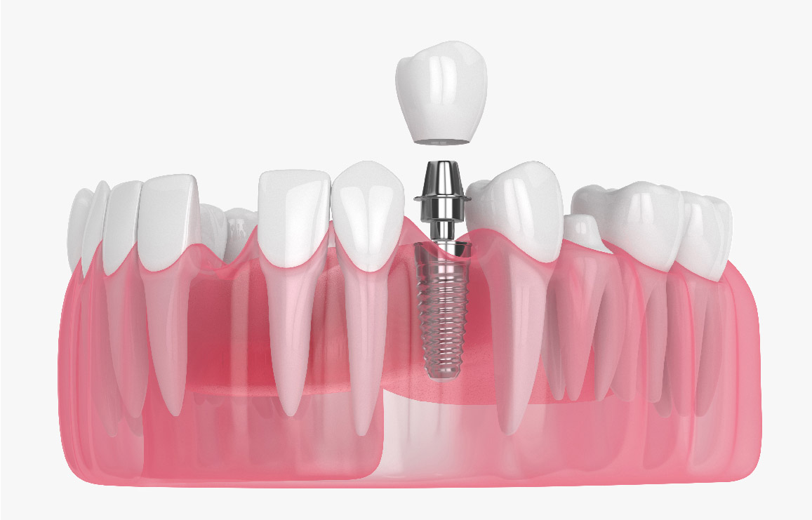 รากฟันเทียม Dental Implant คลินิกทันตกรรมแอพพิคัล