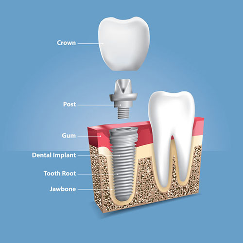 Dental implant result at Apical Dental Clinic Samut Prakan