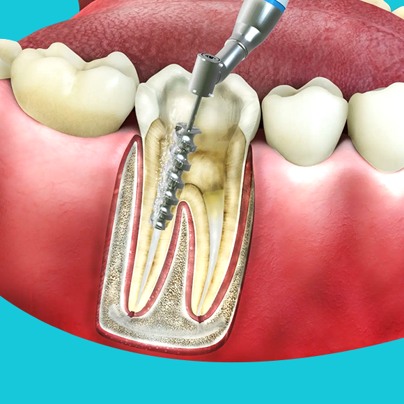 รักษารากฟัน Root Canal Treatment คลินิกทันตกรรมแอพพิคัล