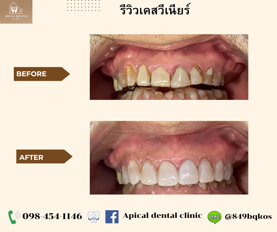 Before After วีเนียร์ คลินิกทันตกรรมแอพพิคัล