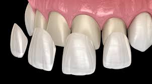 วีเนียร์ Veneer คลินิกทันตกรรมแอพพิคัล