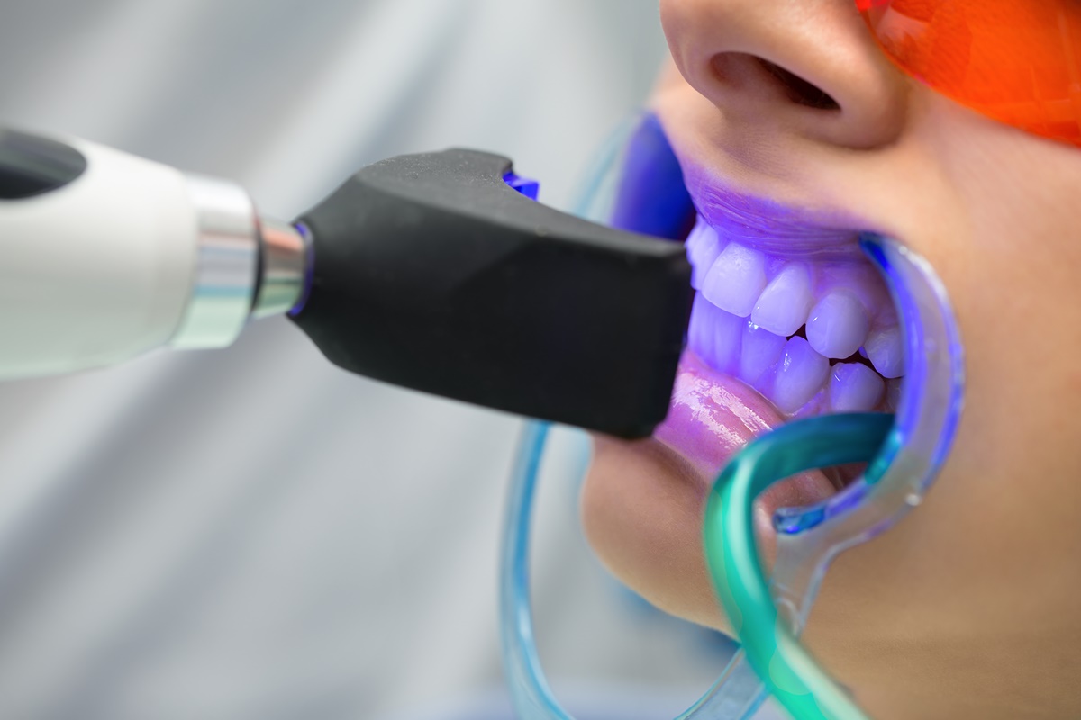ฟอกสีฟัน Teeth Whitening คลินิกทันตกรรมแอพพิคัล